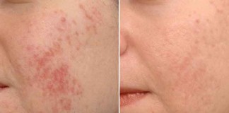 cach-tri-mun-bang-bia