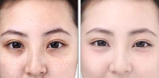 cach-tri-nam-hieu-qua-bang-ruou