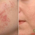 Cách trị mụn BẰNG BIA cho da hỗn hợp, da khô và da dầu hiệu quả. cach-tri-mun-bang-bia