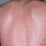 Uống bia rượu bị ngứa người, nguyên nhân và cách chữa dị ứng bia bi-ngua-khi-uong-ruou-bia